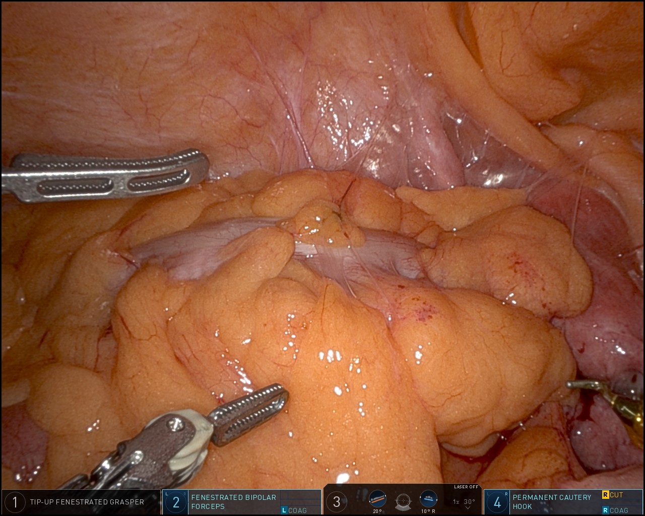 Colon Cancer